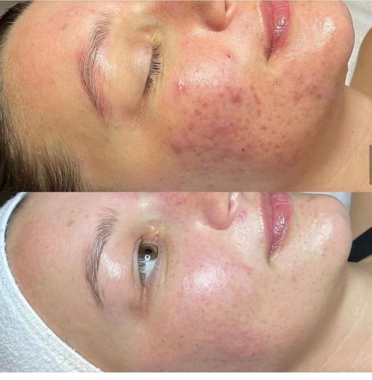 Procell Before and After