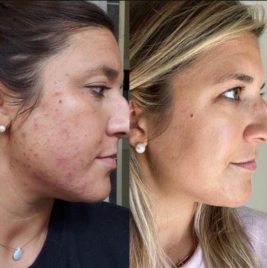 Procell for Acne Scarring